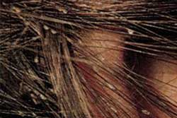 nits on hair
