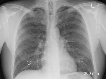 Chest x-ray