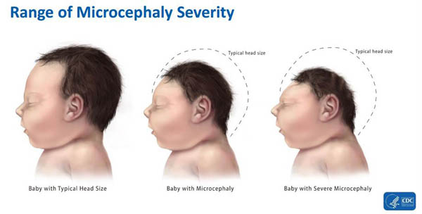 illustration of three babies and how microencephaly prevents a baby's head from growing.