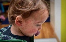 Young child with measles rash on face