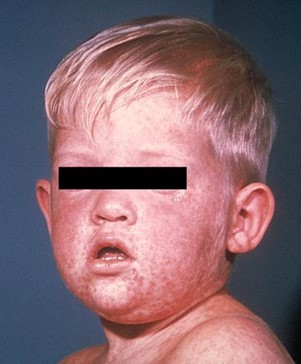 Measles Rash